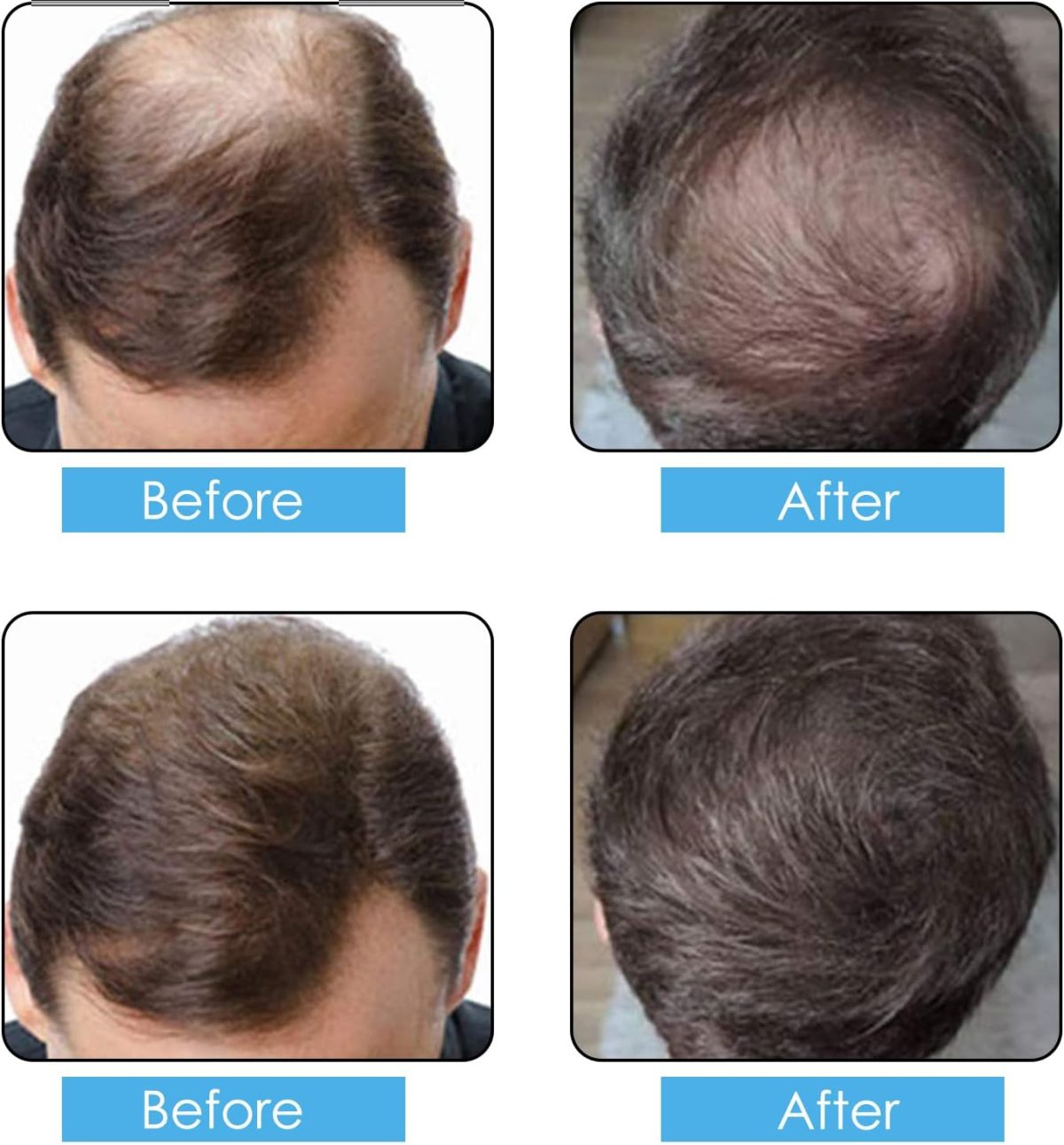 ⁦ALIVER Hair Fibers Spray Refill Powder 100 Grams,Black,Thinning Fine Hair Loss Concealer,Undetected & Unscented,Refill Exsiting Shaker Bottle⁩ - الصورة ⁦2⁩