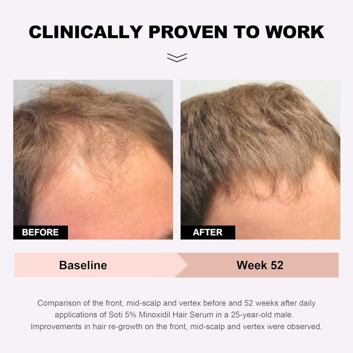 ⁦Soti Minoxidil 5% Hair Growth, Hair Loss Regrowth Serum. Made in USA! Dermatologists Recommended. Ginseng and Biotin Extra Strength Formula (3 Pack)⁩ - الصورة ⁦2⁩