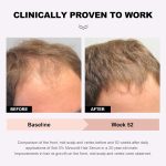 ⁦Soti Minoxidil 5% Hair Growth, Hair Loss Regrowth Serum. Made in USA! Dermatologists Recommended. Ginseng and Biotin Extra Strength Formula (3 Pack)⁩ - الصورة ⁦2⁩