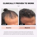 ⁦Soti Minoxidil 5% Hair Growth, Hair Loss Regrowth Serum. Made in USA! Dermatologists Recommended. Ginseng and Biotin Extra Strength Formula (3 Pack)⁩ - الصورة ⁦3⁩